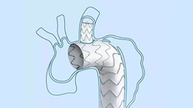 多分支人工血管覆膜支架系統（華脈泰科）